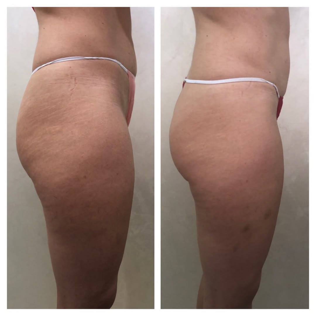 Before and after body wrapping result after 7 sessions at SBW Beauty