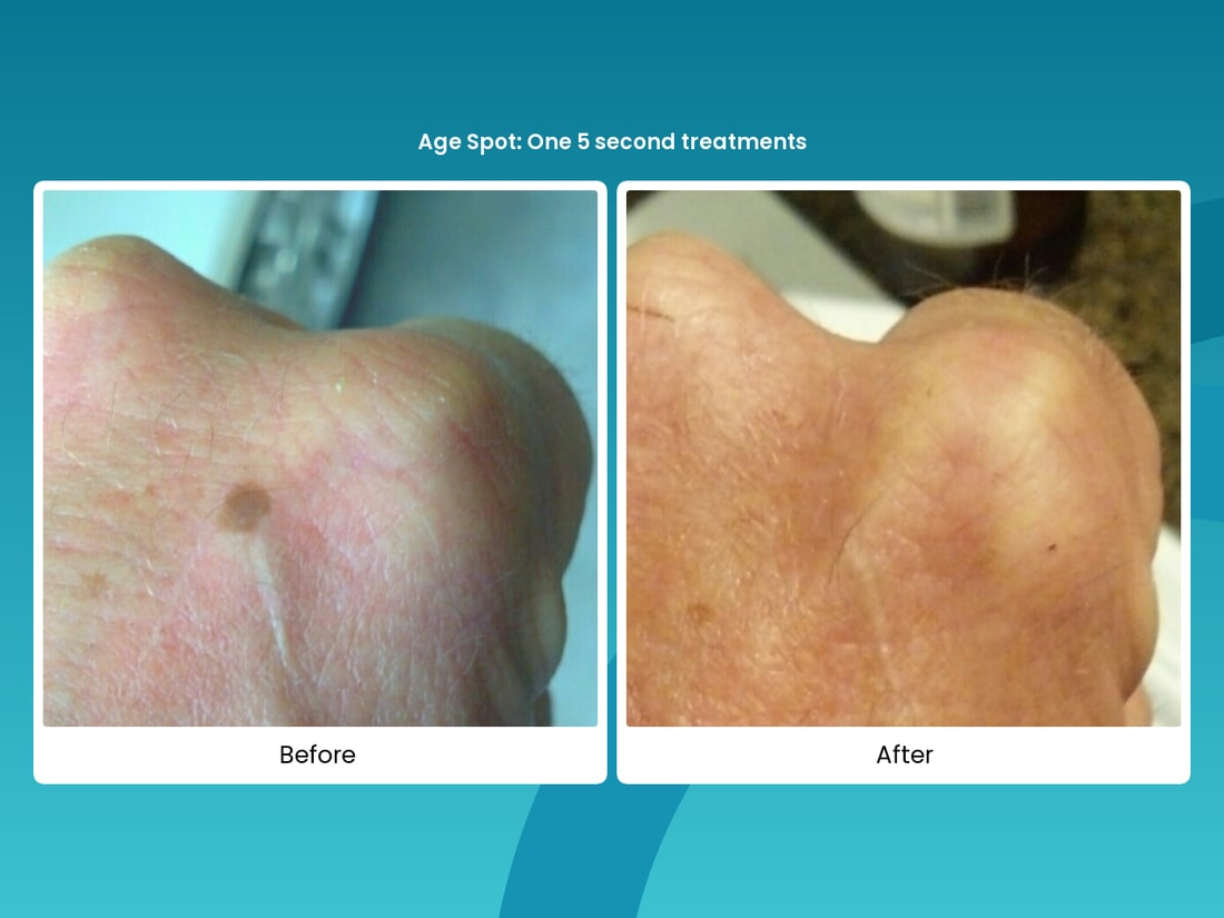 Before and after cryo age spot removal result