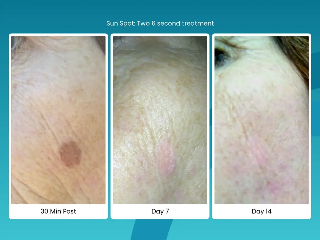 Sun spot cryo treatment healing from treatment to day fourteen