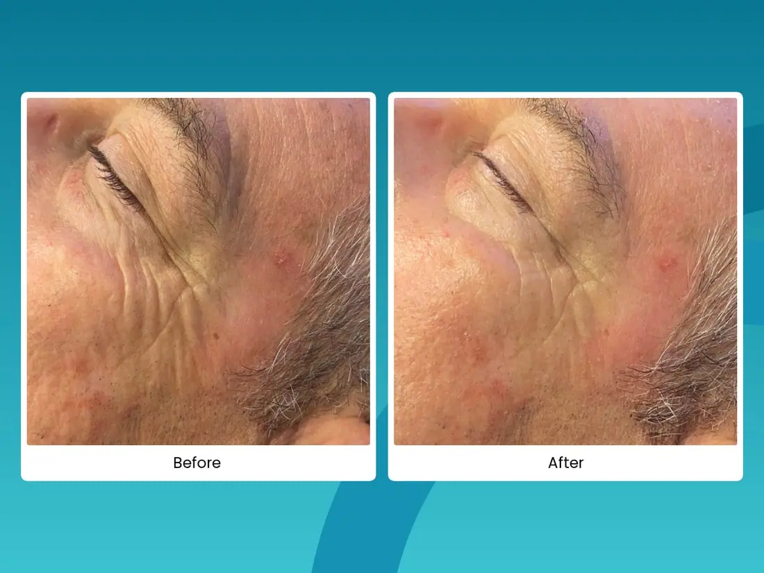 Before and after cryo spot removal on the temple area