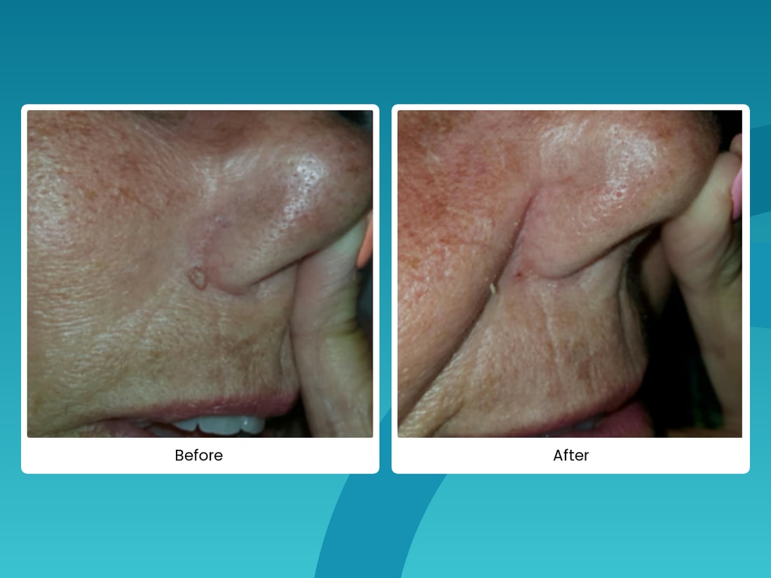 Before and after skin spot removal near the nose