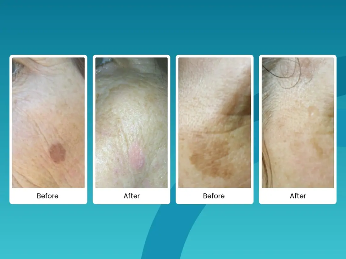 Before and after sun spot and age spot removal comparison