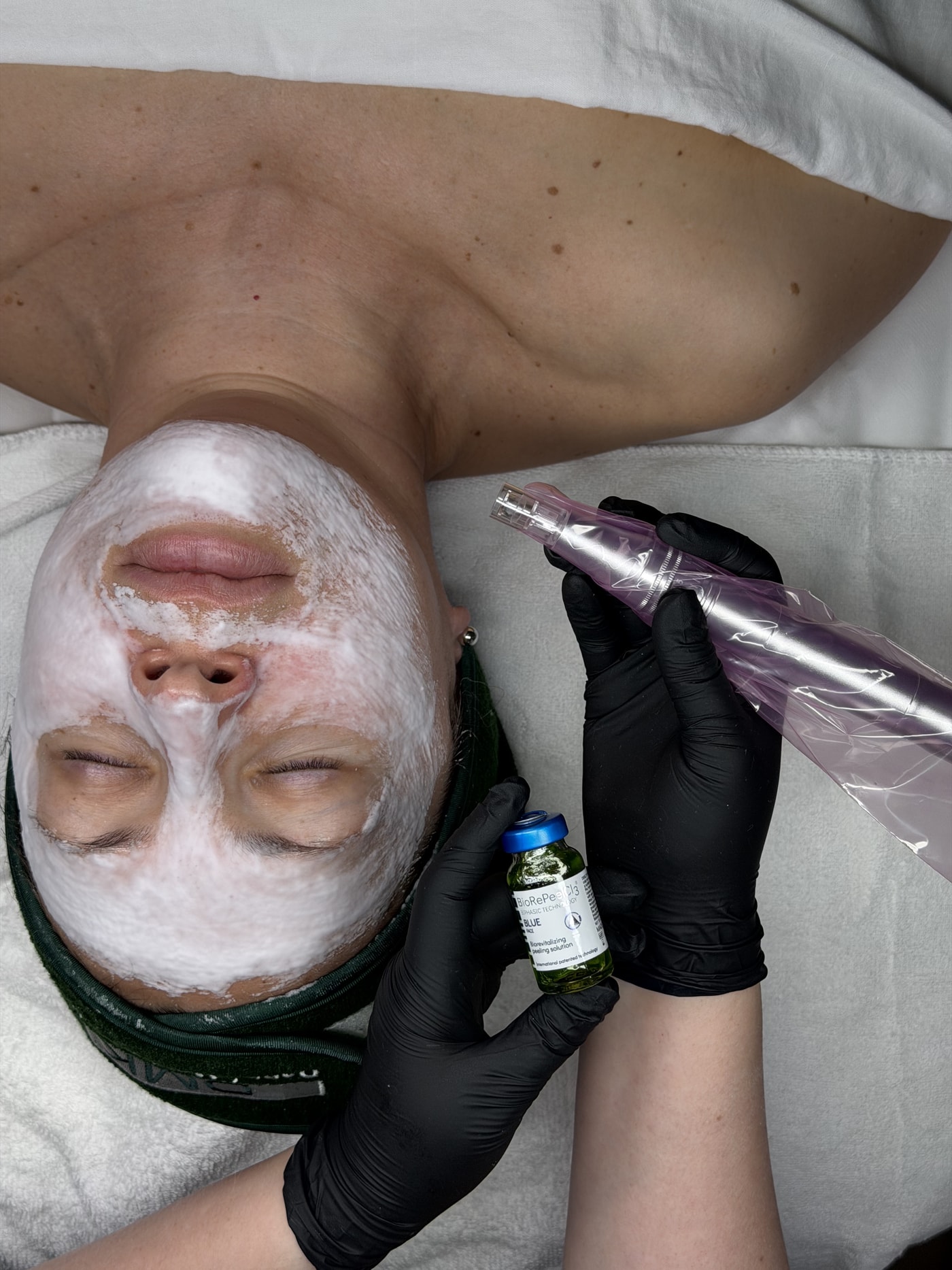 Microneedling add-on treatment at SBW Beauty