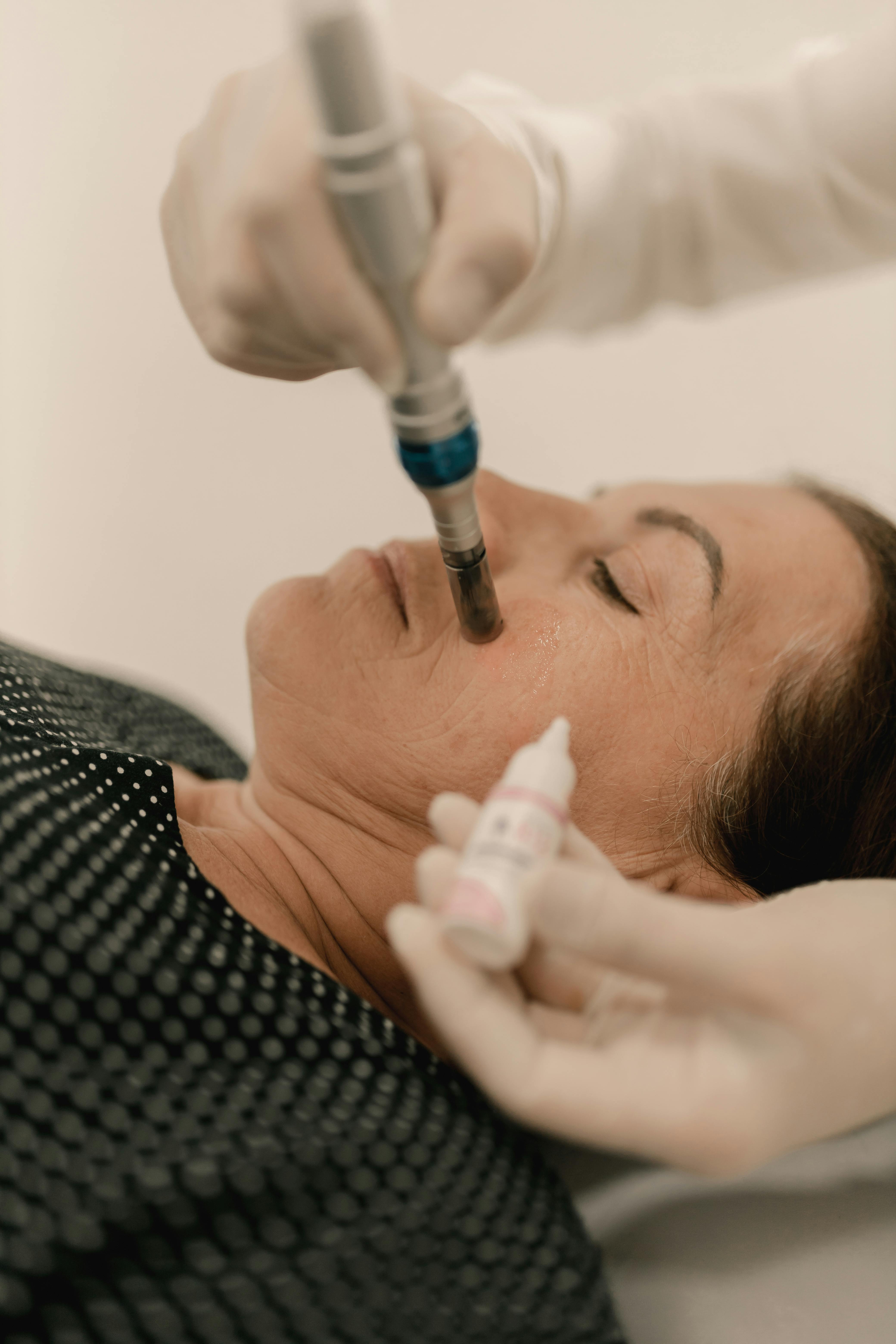 Microneedling with PDRN treatment at SBW Beauty
