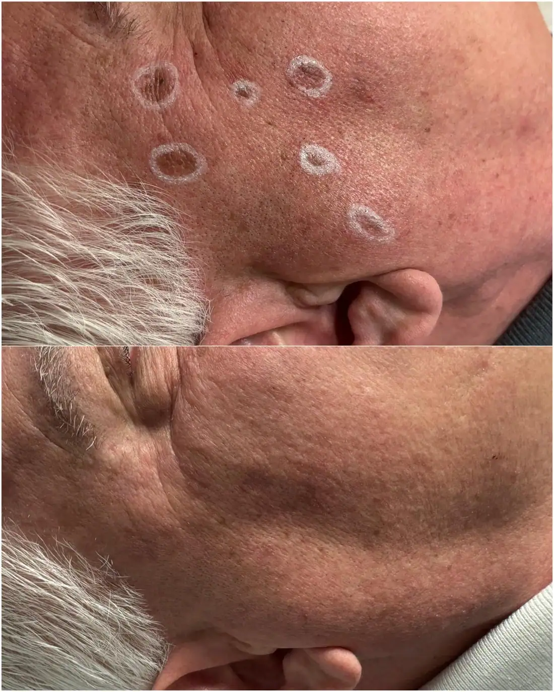 Before and after cryo treatment for facial sun spots and age spots