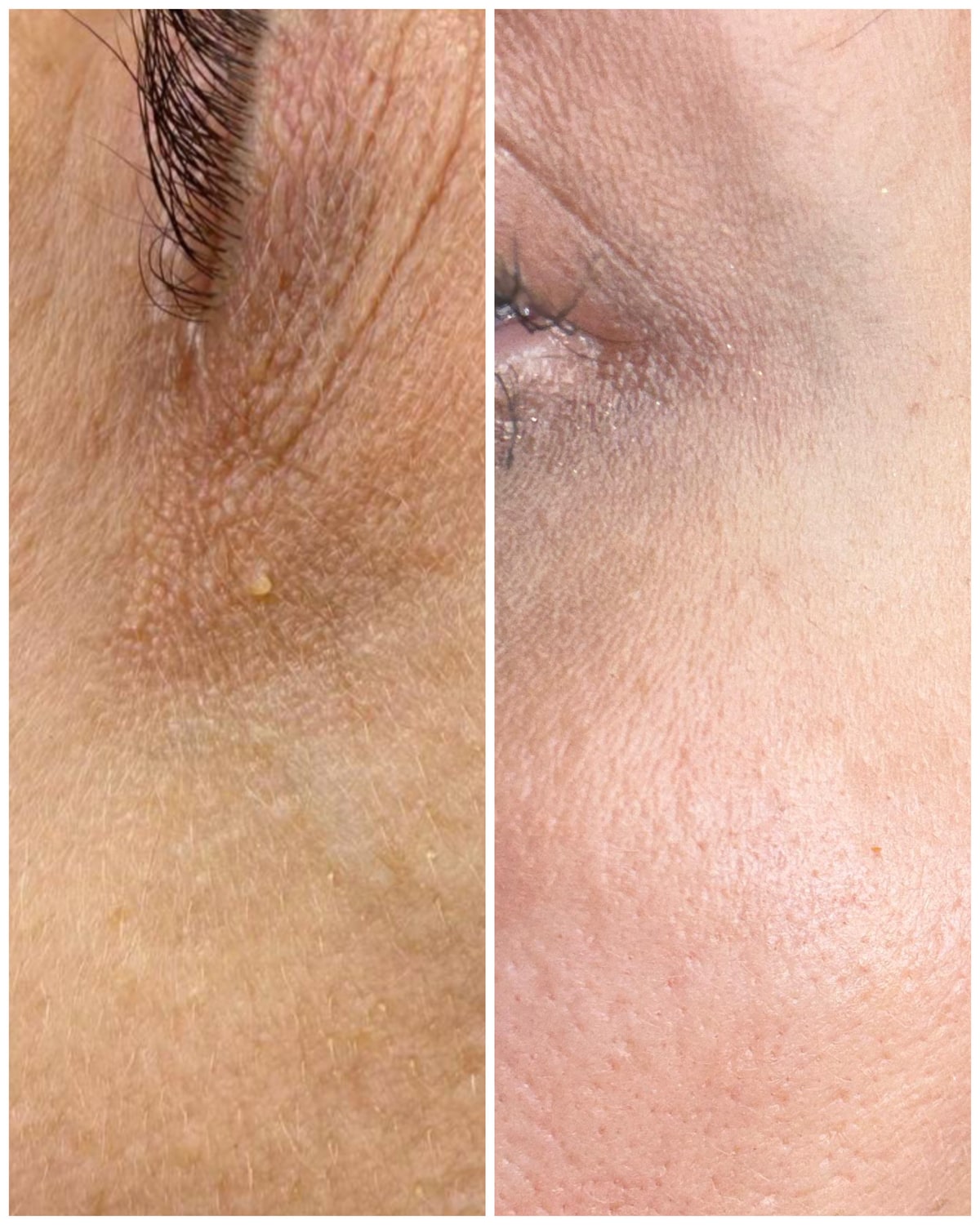 Before and after skin tag removal result at SBW Beauty