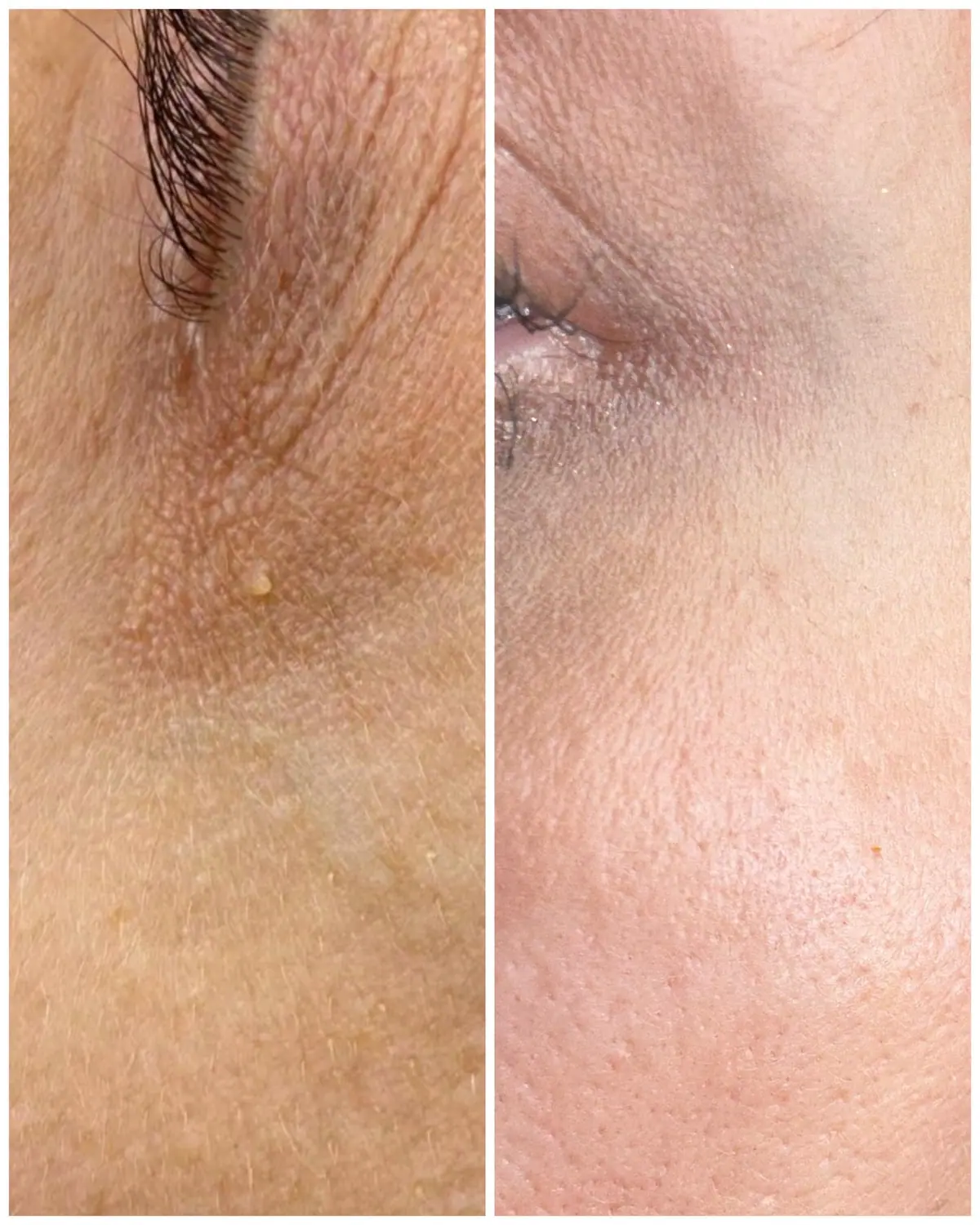Before and after skin tag removal result at SBW Beauty